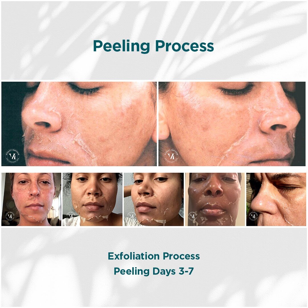 Peeling Process 6