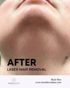 Laser Hair Removal – Case 2