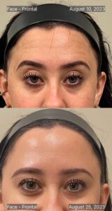 Neuromodulator Botox Forehead and 11s