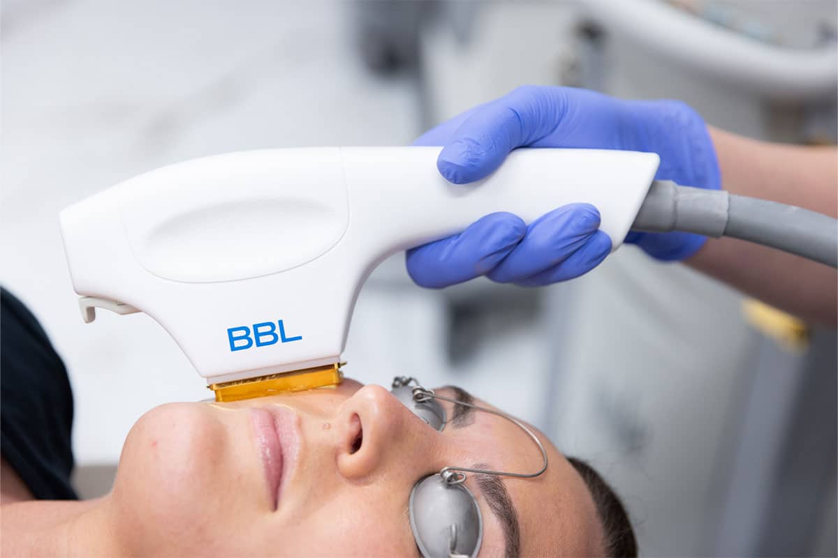 BBL Skin Resurfacing Laser Borealis Med Spa