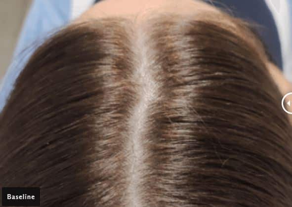 folix baseline