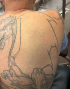 After Image: Tattoo Removal