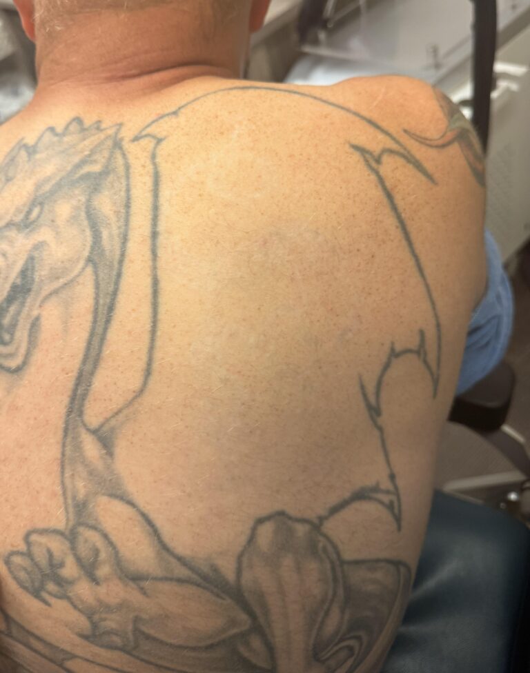 After Image: Tattoo Removal - front