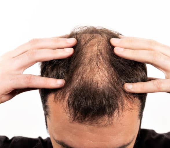 Hair Restoration